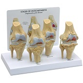 Anatomie model knie met artrose (4 stadia, 8x4x14 cm)