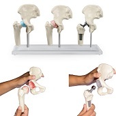 Anatomie model heupgewricht met prothese