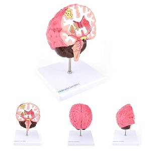 Anatomie model vaatziekten in de hersenen